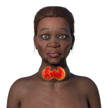 Eine ältere Frau mit Morbus Grave, Darstellung vergrößerter Schilddrüse und Exophthalmus, 3D-Illustration.