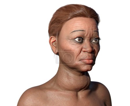 An elderly woman with Grave's disease, depicting enlarged thyroid gland and exophthalmos, 3D illustration.