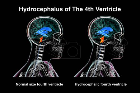 Una ilustración científica en 3D que representa el agrandamiento aislado del cuarto ventrículo cerebral (derecho) en comparación con el tamaño normal del cuarto ventrículo (izquierdo), vista lateral.