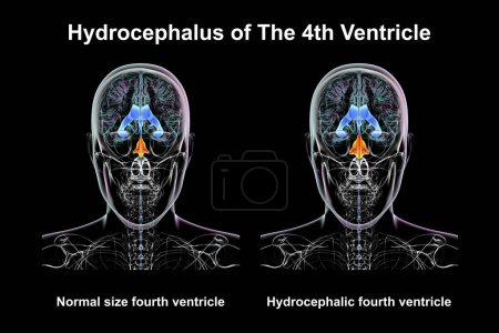 Una ilustración científica en 3D que representa el agrandamiento aislado del cuarto ventrículo cerebral (derecho) en comparación con el tamaño normal del cuarto ventrículo (izquierdo), vista frontal.