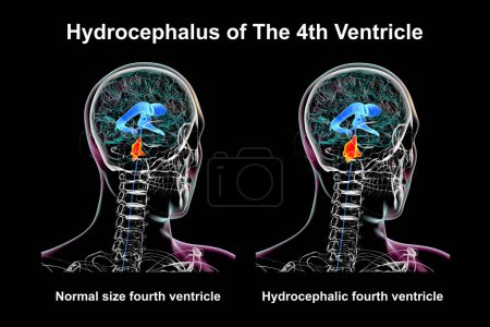 A 3D scientific illustration depicting isolated enlargement of the fourth brain ventricle (right) compared to the normal size fourth ventricle (left).