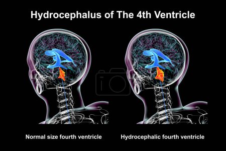 A 3D scientific illustration depicting isolated enlargement of the fourth brain ventricle (right) compared to the normal size fourth ventricle (left).