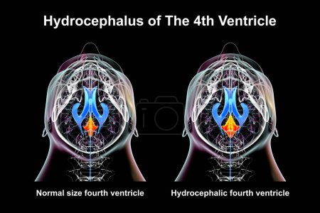 Una ilustración científica en 3D que representa el agrandamiento aislado del cuarto ventrículo cerebral (derecho) en comparación con el tamaño normal del cuarto ventrículo (izquierdo), vista inferior.