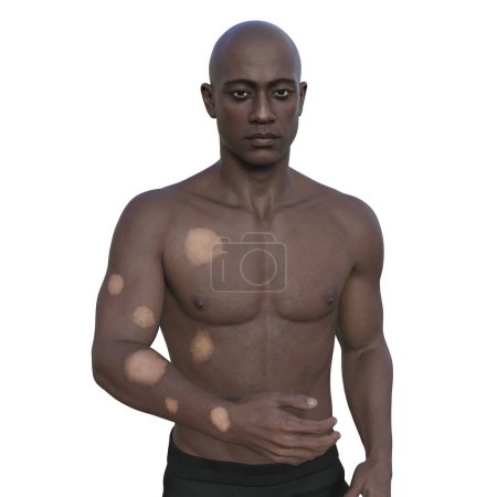 Illustration 3D d'un homme à la peau foncée représentant une lèpre tuberculoïde avec des lésions dépigmentées sur le bras et le tronc.