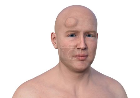 Photo for Lipoma on a man's forehead, a non-cancerous tumor composed of fatty tissue, 3D illustration. - Royalty Free Image