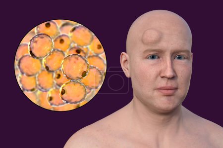 Lipoma on a man's forehead, and close-up view of adipocytes, the fat cells constituting the lipoma growth, 3D illustration.