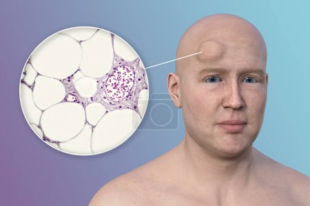 3D illustration of lipoma on a man's forehead, and light micrograph of adipocytes, the fat cells constituting the lipoma growth,