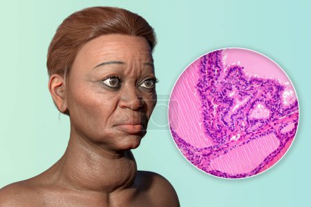 Téléchargez les photos : Illustration 3D d'une femme âgée atteinte de la maladie de Grave, représentant une hypertrophie de la glande thyroïde et une exophtalmie, avec micrographie photonique du goitre toxique. - en image libre de droit