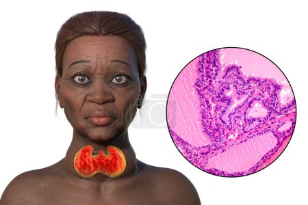 Photo for 3D illustration of an elderly woman with Grave's disease, depicting enlarged thyroid gland and exophthalmos, with light micrograph of toxic goiter. - Royalty Free Image