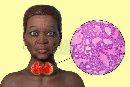 3D illustration of an elderly woman with Grave's disease, depicting enlarged thyroid gland and exophthalmos, with light micrograph of toxic goiter.