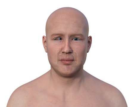 Foto de Un hombre con esotropía, ilustración 3D mostrando desalineación ocular interna. - Imagen libre de derechos