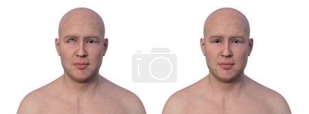 Un homme avec hypertropie et la même personne en bonne santé, illustration 3D avec décalage vers le haut des yeux.
