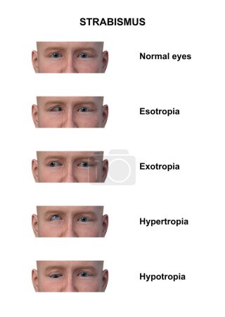 Illustration 3D annotée d'un homme présentant divers types de strabisme : ésotropie, exotropie, hypertropie et hypotropie.