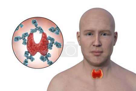 3D-Illustration mit einem Mann mit hervorgehobener Schilddrüse, Darstellung der autoimmunen Hashimoto-Krankheit mit Antikörpern, die die Drüse angreifen.