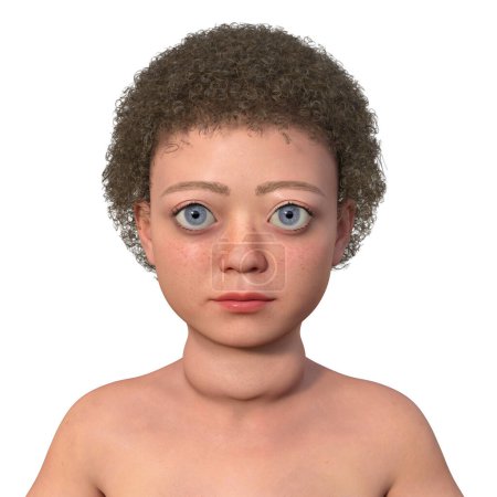 Ein Kind mit Graves 'Krankheit, 3D-Illustration mit vergrößerter Schilddrüse (Kropf) und prallen Augen (Exophthalmus)).