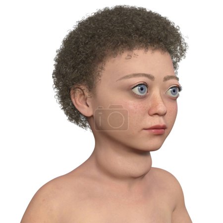 Ein Kind mit Graves 'Krankheit, 3D-Illustration mit vergrößerter Schilddrüse (Kropf) und prallen Augen (Exophthalmus)).