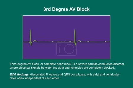 Illustration 3D visualisant un ECG avec bloc AV au 3ème degré, montrant une dissociation complète entre les rythmes auriculaire et ventriculaire.