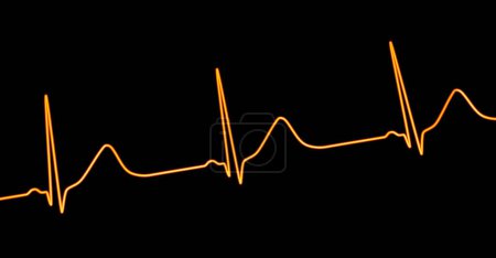 Ilustración 3D de un electrocardiograma (ECG) que muestra un intervalo QT prolongado con ondas T de amplia base, característica del síndrome de QT largo tipo 1.