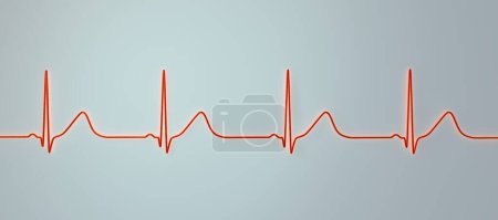 Illustration 3D d'un électrocardiogramme (ECG) montrant un intervalle QT prolongé avec des ondes T larges, caractéristique du syndrome QT long de type 1.