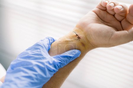 Téléchargez les photos : D'en haut chirurgien méconnaissable en gant de latex bleu toucher le bras du patient et vérifier les points de suture sur la blessure pendant le travail à l'hôpital - en image libre de droit