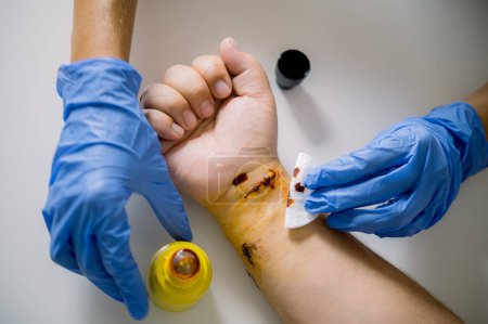 Foto de Vista superior del cirujano anónimo en guantes de látex limpiando puntos cubiertos con yodo en la muñeca del paciente de la cosecha en la mesa gris en el hospital - Imagen libre de derechos