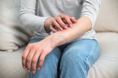 Focus sélectif sur la main de la femme avec une réaction allergique rougeur. Problèmes dermatologiques : démangeaisons, sensibles, atopiques, peau sèche, eczéma, rosacée, séborrhéique. Bras femelles cultivés avec inflammation