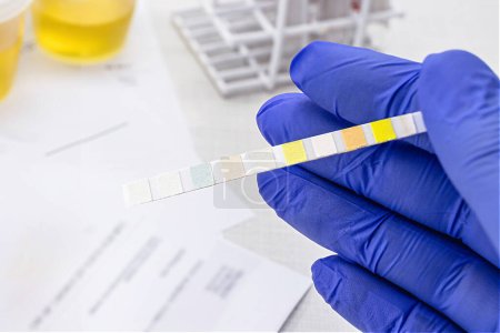 analyse d'urine avec des bandelettes de réactif pour analyser les leucocytes, urobilinogène, bilirubine, sang, nitrite, pH, densité, protéines, glucose et corps cétose.