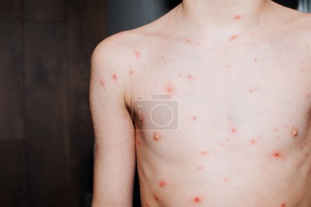 Viral diseases with a rash on the body. Chickenpox on the childs body. Treatment of chickenpox. Front view