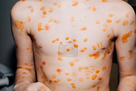 Viral diseases with a rash on the body. Chickenpox on the childs body. Treatment of chickenpox. Front view