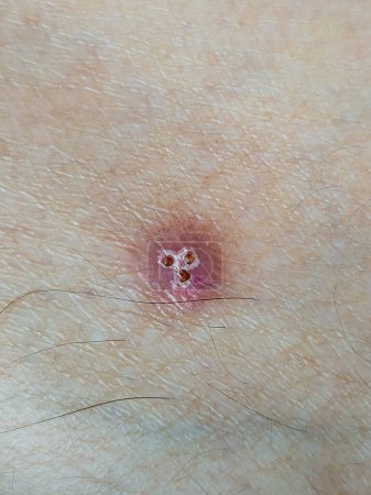 Téléchargez les photos : Tavelure mordue avec cicatrice sur la peau d'une jambe adolescente - en image libre de droit