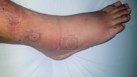 Diabetes mellitus wound, blisters, boils, infections, rash of the foot. Infected wound, treatment of a diabetic patient's leg infection. skin itchy, skin disease, skin problems at patient