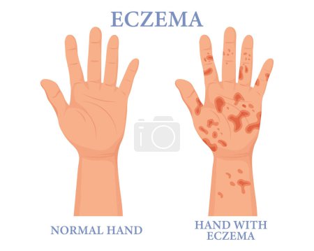 Illustration for Eczema, healthy and unhealthy hand. Dermatology. The concept of medicine and healthcare. Poster, banner, vector - Royalty Free Image