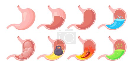 Illustration for Healthy and unhealthy, empty and full human stomach, icons set. Nutrition, stomach pain, heartburn, heaviness, bloating. Anatomy of the digestive system. vector - Royalty Free Image