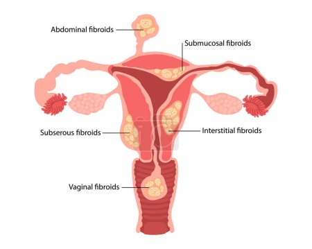Illustration for Diagram of types of uterine fibroids of a woman on a white background. Genicolgia. Medical concept. Infographics banner. Vector - Royalty Free Image
