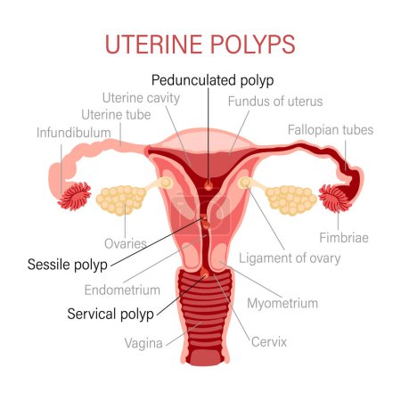Ilustración de Types of uterine polyps. Diseases of the female reproductive system. Gynecology. Medical concept. Infographic banner. Vector - Imagen libre de derechos