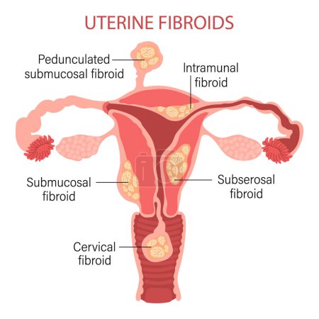 Illustration for Types of uterine fibroids in women. Fibroids. Diseases of the female reproductive system. Gynecology. Medical concept. Infographic banner. Vector - Royalty Free Image