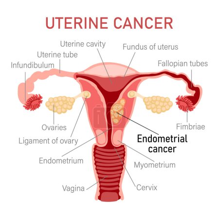 Illustration for Uterine cancer. Diseases of the female reproductive system. Gynecology. Medical concept. Infographic banner. Vector - Royalty Free Image