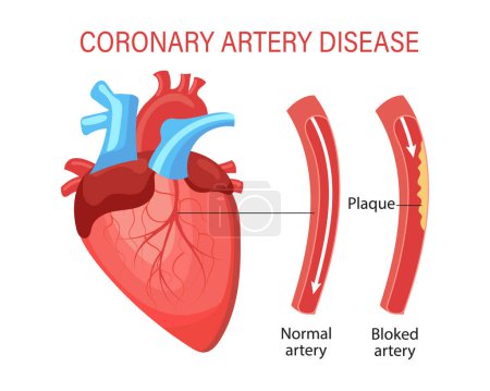 Ilustración de Enfermedad de la arteria coronaria del corazón. Anatomía humana, concepto médico. Infografías, banner, vector - Imagen libre de derechos