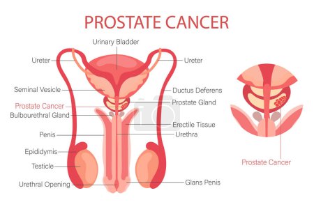 Ilustración de El cáncer de próstata. Sistema reproductor masculino. Anatomía de los órganos internos del hombre. Banner de infografía, diagrama, vector - Imagen libre de derechos