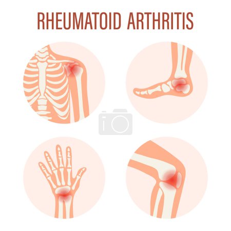 Symbole der rheumatoiden Arthritis. Kniegelenk, Schultergelenk, Handgelenk, Fußgelenk. Arten von Arthritis. Medizinisches Konzept. Vektor