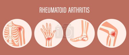 Symbole der rheumatoiden Arthritis. Kniegelenk, Schultergelenk, Handgelenk, Fußgelenk. Arten von Arthritis. Medizinisches Konzept. Vektor