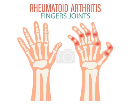 Illustration for Rheumatoid arthritis. Osteoarthritis of the joints of the fingers and toes. Medical concept. Infographic poster, banner, vector - Royalty Free Image