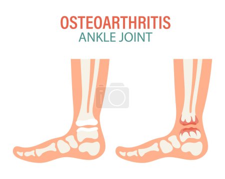Illustration for Rheumatoid arthritis. Osteoarthritis of the human ankle joints. Medical concept. Infographic poster, banner, vector - Royalty Free Image