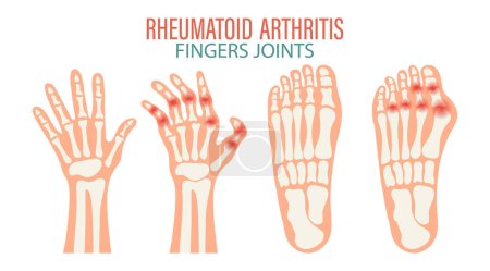Artritis reumatoide. Osteoartritis de las articulaciones de los dedos de las manos y los pies. Concepto médico. Cartel de infografía, banner, vector