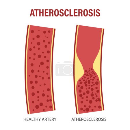 Illustration for Healthy and atherosclerotic vessels with blood cells. Cholesterol in blood vessels. Atherosclerotic plaque. Medicine, science, healthcare. Infographics banner - Royalty Free Image