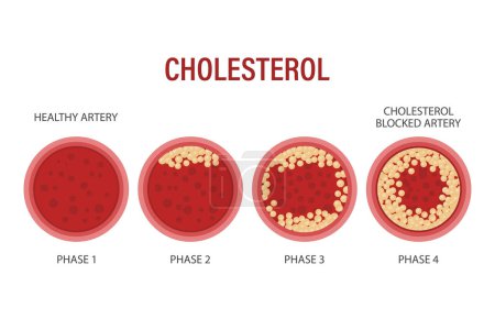 Vascular atherosclerosis. Stages of atherosclerosis Cholesterol in arteries, vessels. Medicine, science, healthcare. infographic banner