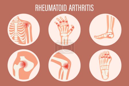 Illustration for Rheumatoid arthritis icons. Knee joint, shoulder joint, wrist joint, hip joint, foot joint. Types of arthritis. Medical concept. Vector - Royalty Free Image