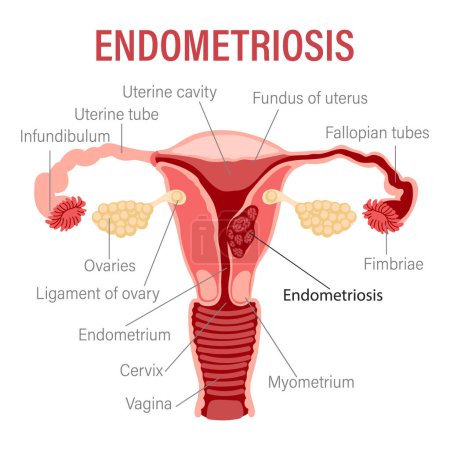 Endométriose, illustration schématique de l'utérus, maladies du système reproducteur féminin. Bannière d'infographie médicale. Vecteur