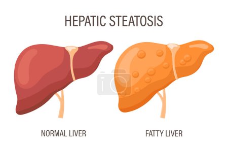 esteatosis hepática, enfermedades hepáticas. Hígado sano e hígado graso. Banner de infografía médica. Vector