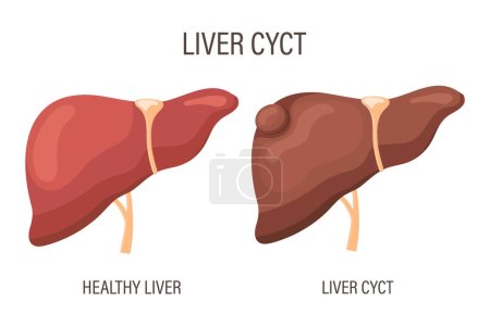 Illustration for Liver cyst, liver disease. Healthy liver and liver cyst. Medical infographic banner. Vector - Royalty Free Image